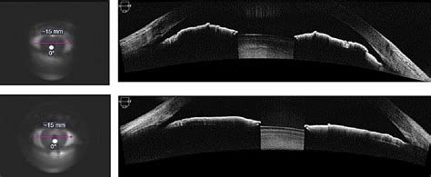 06_OCT_Segmento_anterior 06_OCT_Segmento_anterior